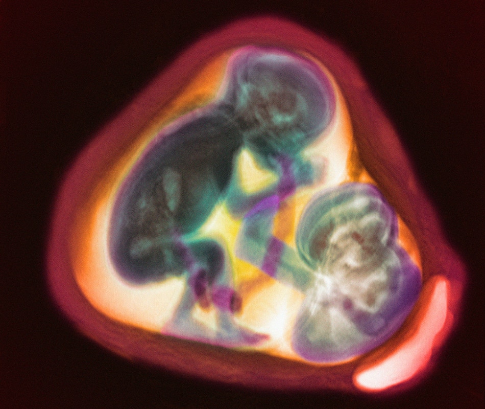 emag4_d1c_week_twin_foetuses_mri_scan_800x950.png
